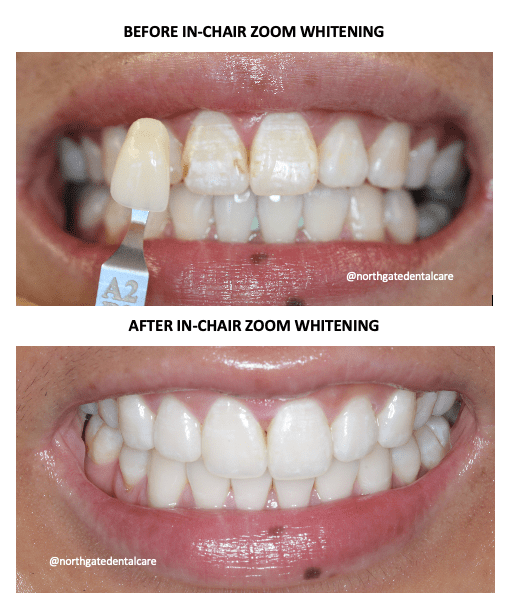 Teeth Whitening ZOOM Dental Treatment