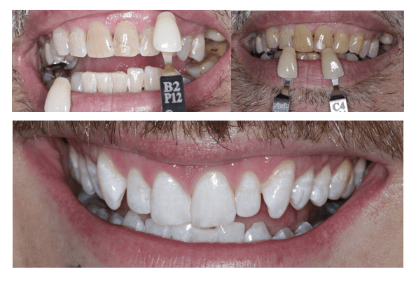 Teeth Whitening ZOOM Dental Treatment